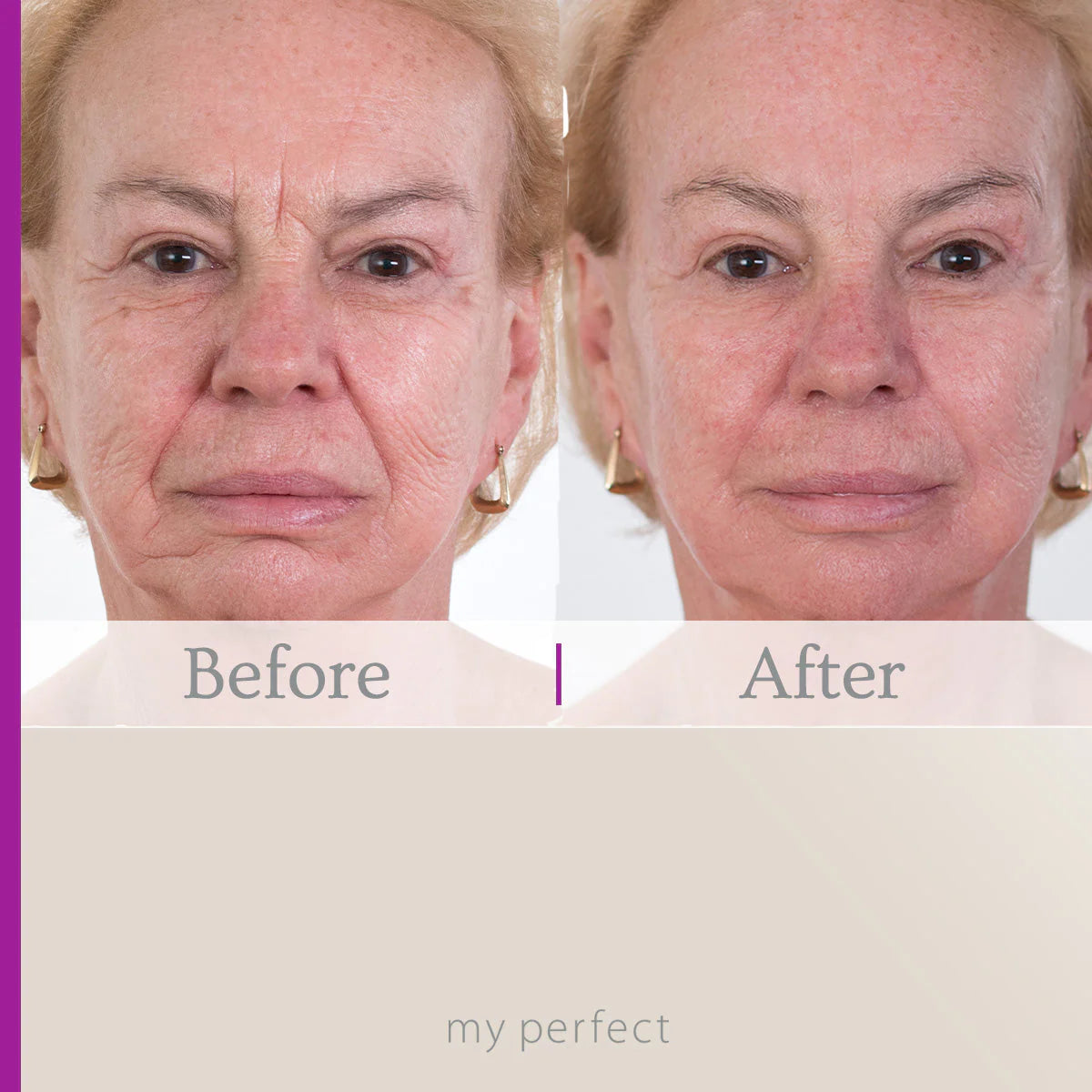 My Perfect Facial with 4x Dermaplaning Tools FREE - Deal of the Week!