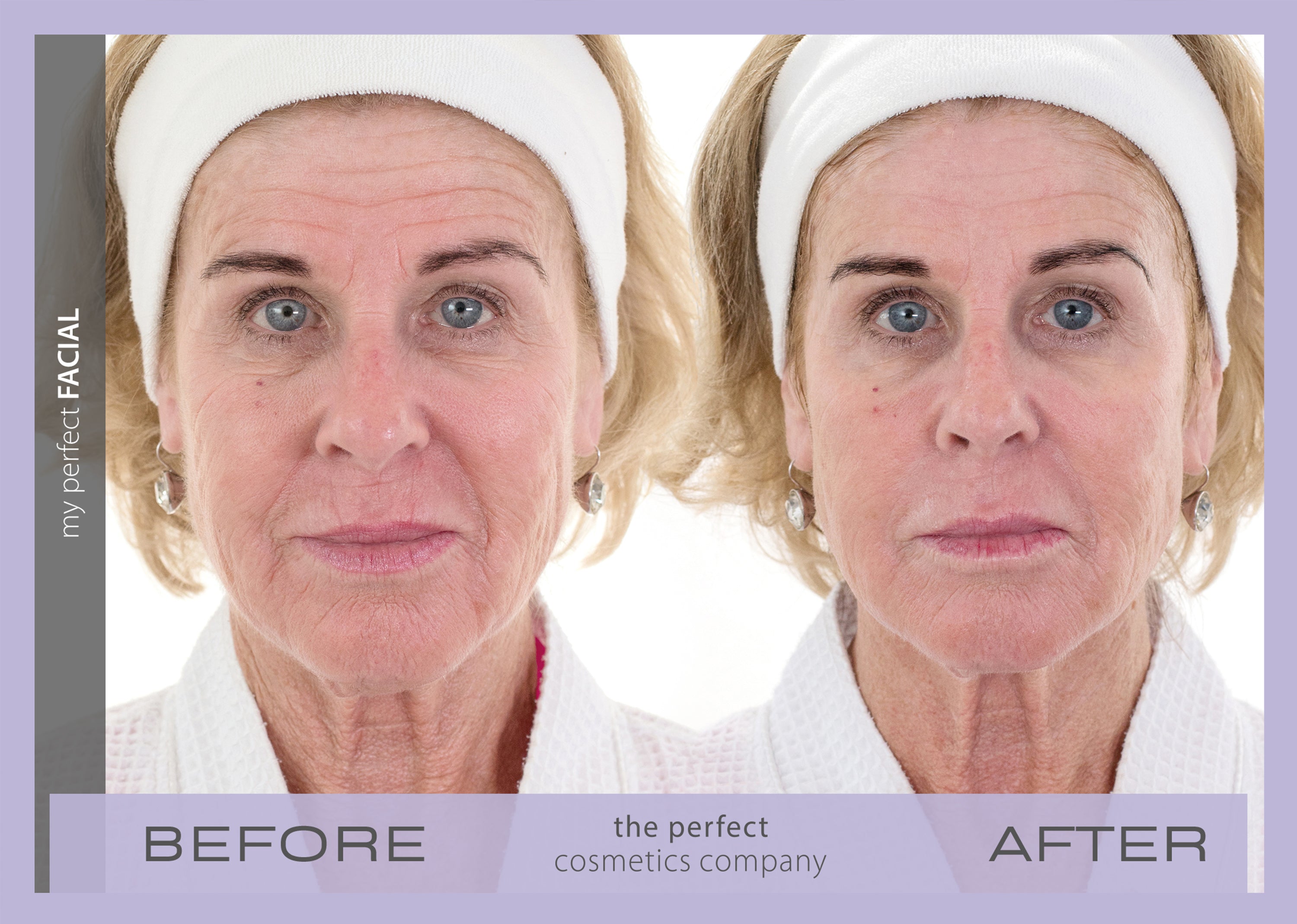 My Perfect Facial before and after results showing visible skin tightening and reduced wrinkles, delivering non-surgical facial rejuvenation for a youthful appearance.