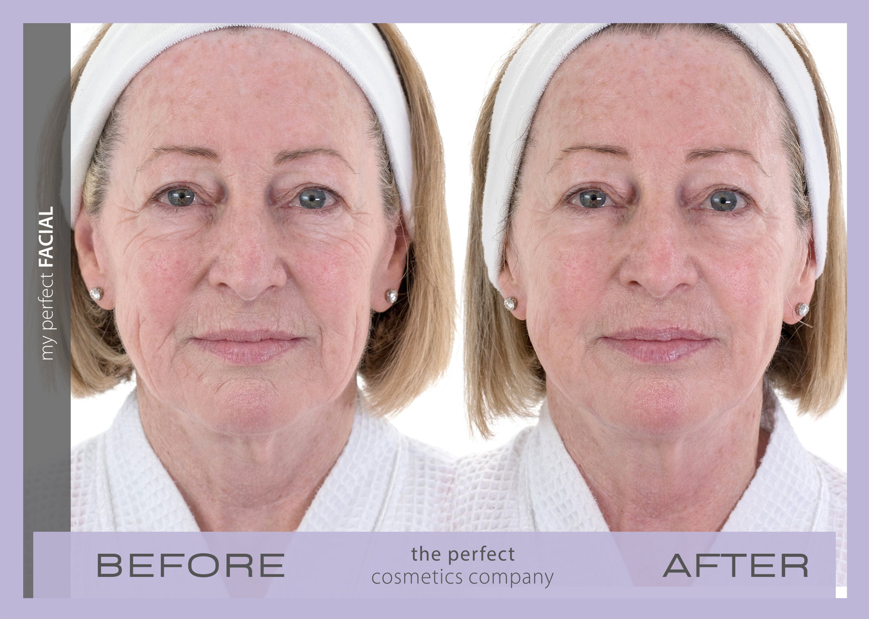 My Perfect Facial before and after results showing visible skin tightening and reduced wrinkles, delivering non-surgical facial rejuvenation for a youthful appearance.