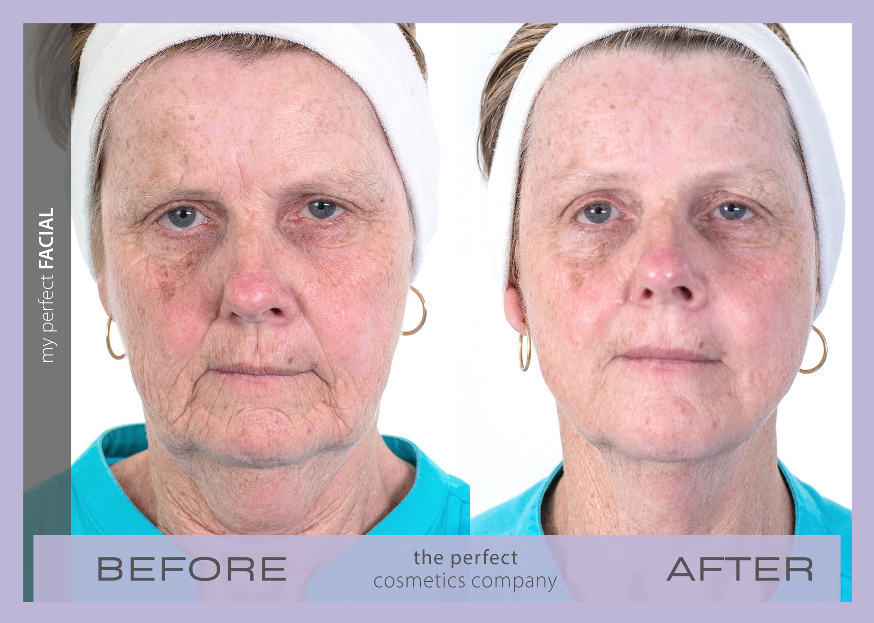 My Perfect Facial before and after results showing visible skin tightening and reduced wrinkles, delivering non-surgical facial rejuvenation for a youthful appearance.