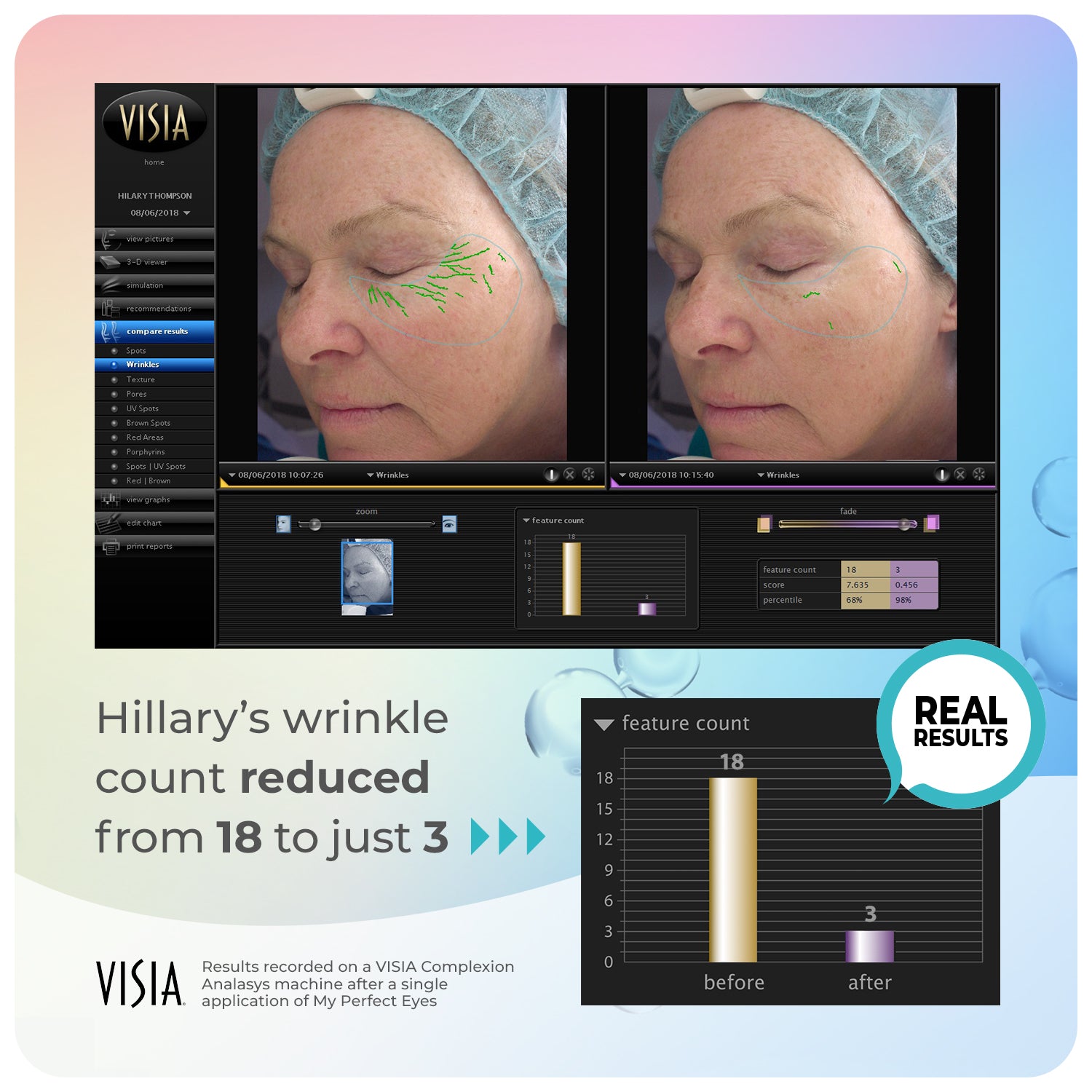 VISIA wrinkle count results for My Perfect Eyes